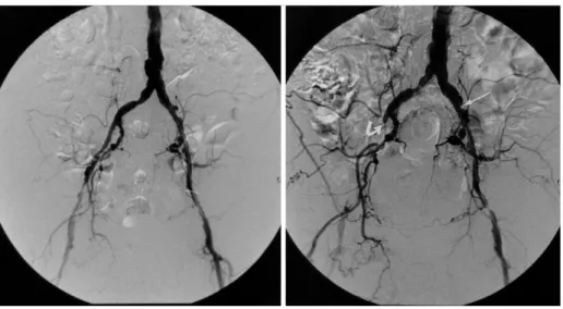 Fig. 2. A 68-year-old male patient underwent left common iliac artery and external iliac artery stent placement on October 1994