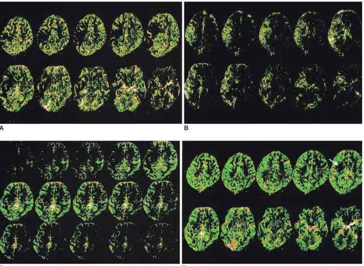 Fig. 2. A 26-year-old female with arrhythmia showed a right middle cerebral artery occlusion on the magnetic resonance angiography and high signal intensity at the right basal ganglia on the diffusion weighted image (not shown) 3 hours after developing a l