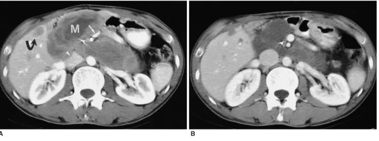 Fig. 1. A 34-year-old man with peritoneal seeding and liver metastases after resection of gastrointestinal stromal tumor of the duodenum.