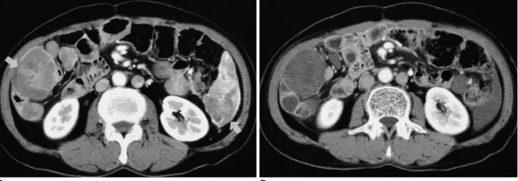 Fig. 3. A 52-year-old man with peritoneal seeding after resection of gastrointestinal stromal tumor of the mesentery.