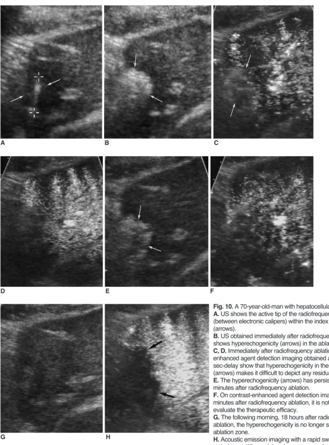 Fig. 10. A 70-year-old-man with hepatocellular carcinoma . A. US shows the active tip of the radiofrequency electrode (between electronic calipers) within the index tumor (arrows).