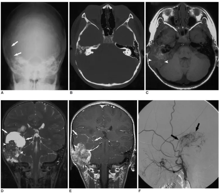 Fig. 1. A 7-year-old boy with high grade hemangioendothelioma of the right temporal bone.