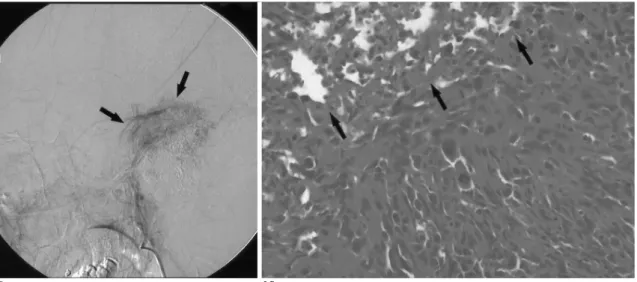 Fig. 1. G. The lesion still remained hypervascular on the late venous phase due to delayed washout of contrast media