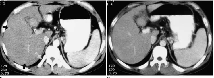 Fig. 3. In this 65-year-old man, spiral CT imaging revealed false- false-positive lesions.
