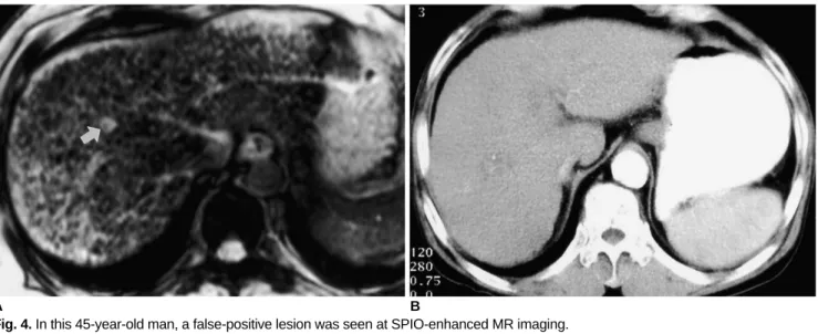 Fig. 4. In this 45-year-old man, a false-positive lesion was seen at SPIO-enhanced MR imaging.