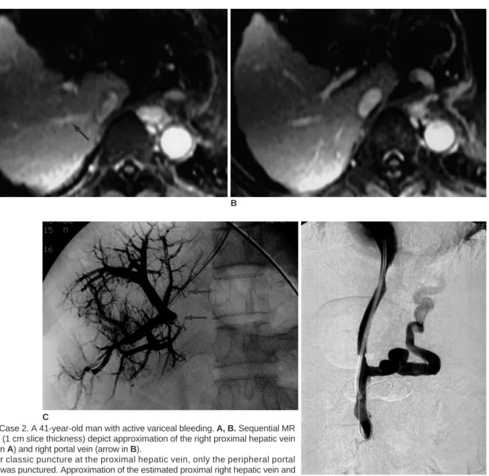 Fig. 1. Case 2. A 41-year-old man with active variceal bleeding. A, B. Sequential MR images (1 cm slice thickness) depict approximation of the right proximal hepatic vein (arrow in A) and right portal vein (arrow in B).
