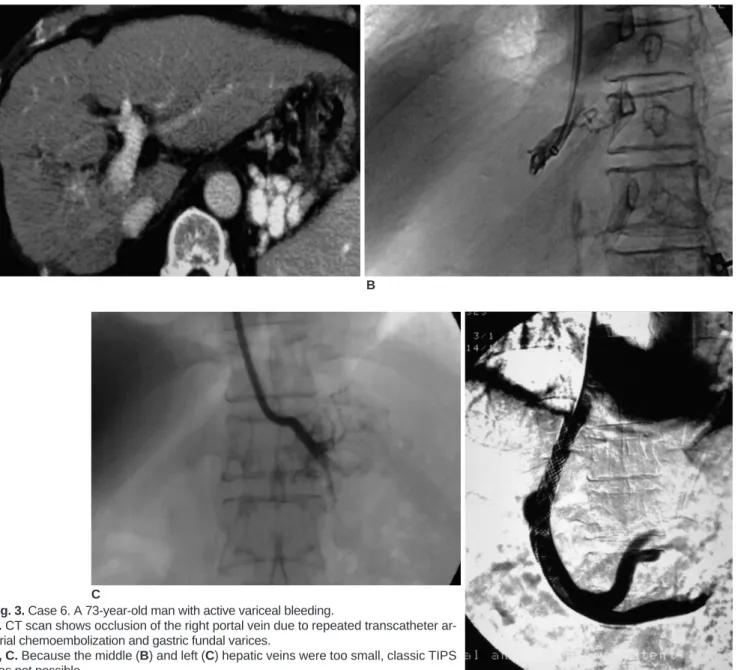 Fig. 3. Case 6. A 73-year-old man with active variceal bleeding.