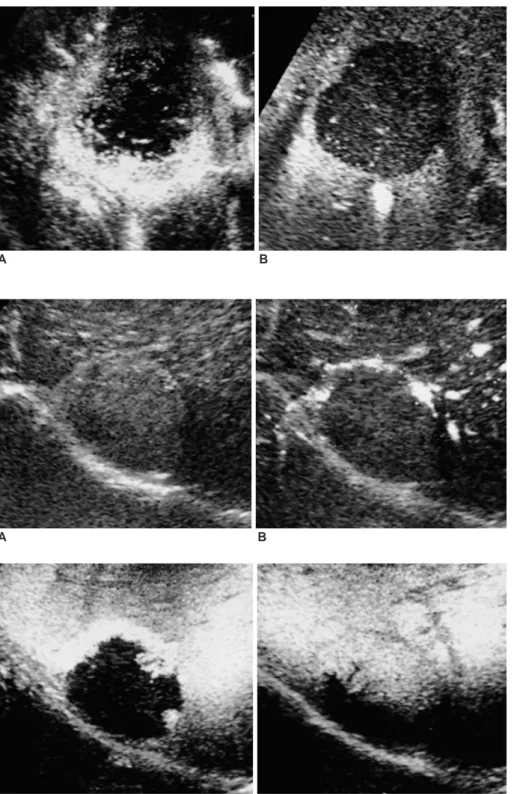 Fig. 4. Metastasis from duodenal carci- carci-noma. Serial acoustic emission image depicts rim-or flame-like enhancement during the early phase (A, 40-sec delay) and a homogeneous perfusion defect during a later phase (B, 5-min delay).
