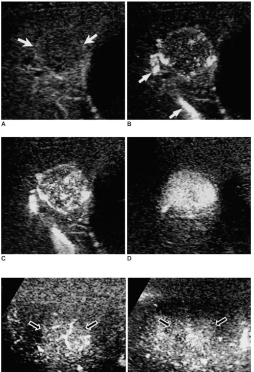 Fig. 7. FNH (arrows). CHA images clear- clear-ly depict the typical spoke-wheel pattern seen during the early vascular phase (A, 40-sec delay)