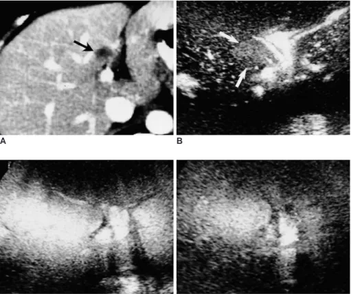 Fig. 8. Focal fatty lesion in a breast can- can-cer patient. Portal venous phase CT (A) shows a target-like hepatic nodule  (ar-row)