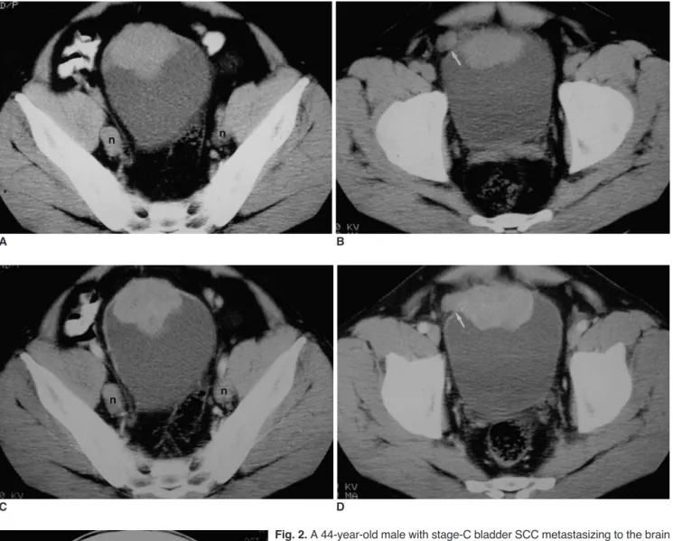 Fig. 2. A 44-year-old male with stage-C bladder SCC metastasizing to the brain (Case 1).