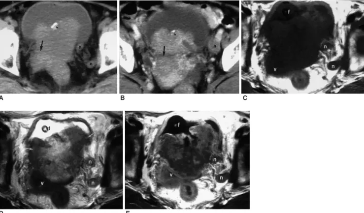 Fig. 3. A 59-year-old female with stage D1 SCC of the urinary bladder (Case 6).