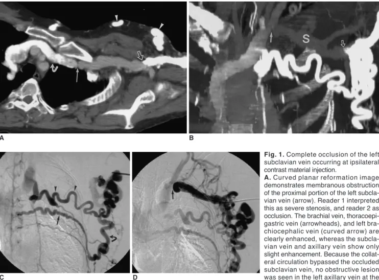 Fig. 1. Complete occlusion of the left subclavian vein occurring at ipsilateral contrast material injection.