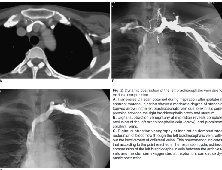 Fig. 2. Dynamic obstruction of the left brachiocephalic vein due to extrinsic compression.