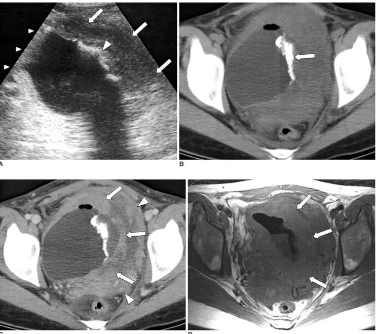 Fig. 1. A 30-year-old woman with primary lymphoma of the urinary bladder. 