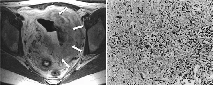 Fig. 1E. At T2-weighted fast spin-echo imaging (TR/TE = 3,500/78 msec), high signal intensity is observed (arrows)