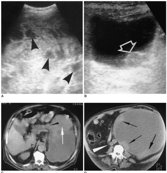 Fig. 1A. Sonogram of 12 cm-mass component located on top of the tumor shows variable echogenity with heterogeneous hyperechoic areas mixed with less echoic areas or small cysts presenting cystic necrosis (arrowheads).