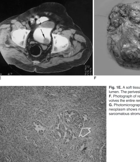 Fig. 1E. A soft tissue sessile mass (arrow) extends into the bladder lumen. The perivesical fat planes are intact.