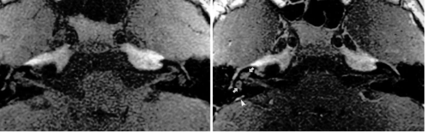 Fig. 2. An 11-year-old girl with mumps who presented with sensorineural hearing loss, vertigo, and tinnitus