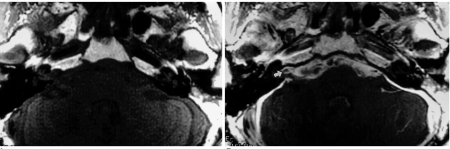 Fig. 6. A 52-year-old man with leptomeningitis, and a history of ventriculoperitoneal shunt procedure, who presented with sensorineural hearing loss and vertigo