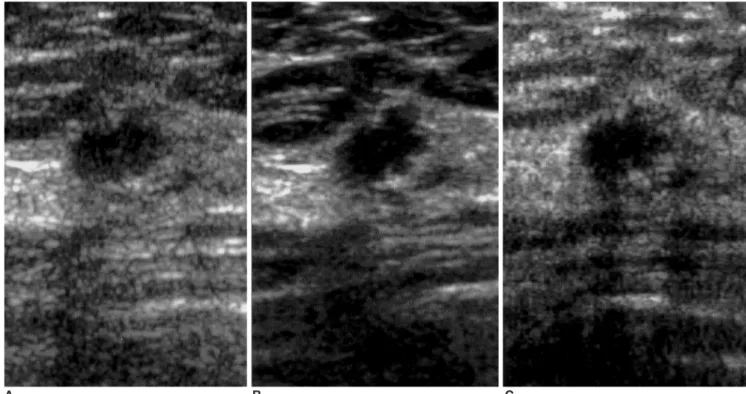 Fig. 1. Sonograms of a 56-year-old woman show an oval-shaped, microlobulated and spiculated marginated, hypoechoic nodule