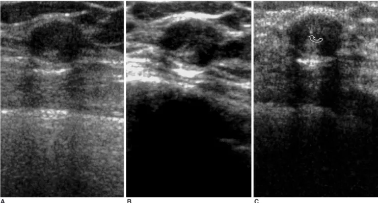 Fig. 3. Sonograms of a 35-year-old woman depict a septated cyst. The internal transverse thin septum within the cyst is more clearly demonstrated by real-time compound (B) and pulse-inversion harmonic imaging (C) than by conventional scanning (A)
