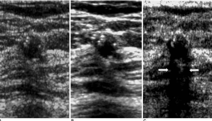Fig. 5. Sonograms of a 52-year-old woman show a well-defined, hypoechoic, round nodule with internal microcalcifications
