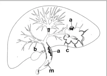 Fig. 1. Schematic drawing of intraductal papillary tumors of the biliary tract (A: carcinoma; B: adenoma; C: dysplasia; m: mucus).