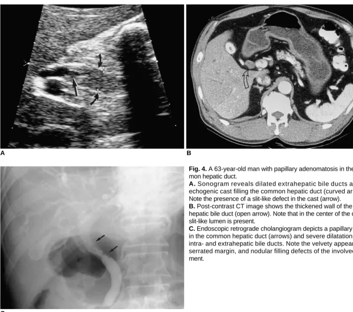 Fig. 4. A 63-year-old man with papillary adenomatosis in the com- com-mon hepatic duct.