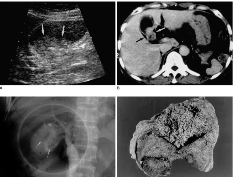Fig. 5. A 56-year-old woman with papillary adenomatosis in which multifocal foci of carcinomatous change are seen in the gallbladder and cystic duct.