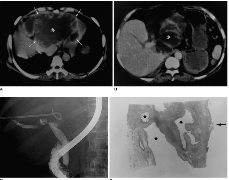 Fig. 6. A 54-year-old woman with a mucin-producing, intraductal mucosal-spreading, papillary adenocarcinoma causing cystic and tubu- tubu-lar dilatation of the intrahepatic bile ducts, complicated by abscess and rupture