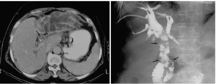 Fig. 7. A 59-year-old woman with papillary carcinomatosis in the left hepatic ducts and extrahepatic ducts.