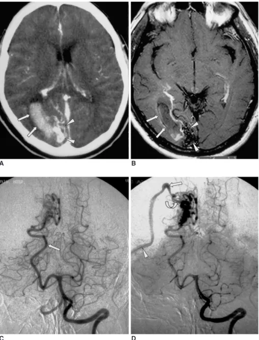 Fig. 1. Initial radiologic studies of an AVM in a 41-year-old man with sudden onset of headache and blurred vision