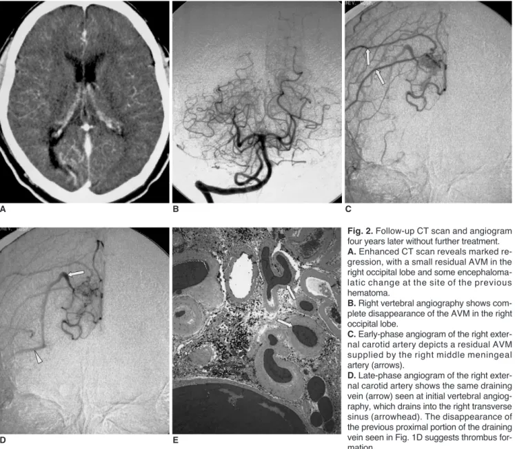 Fig. 2. Follow-up CT scan and angiogram four years later without further treatment.