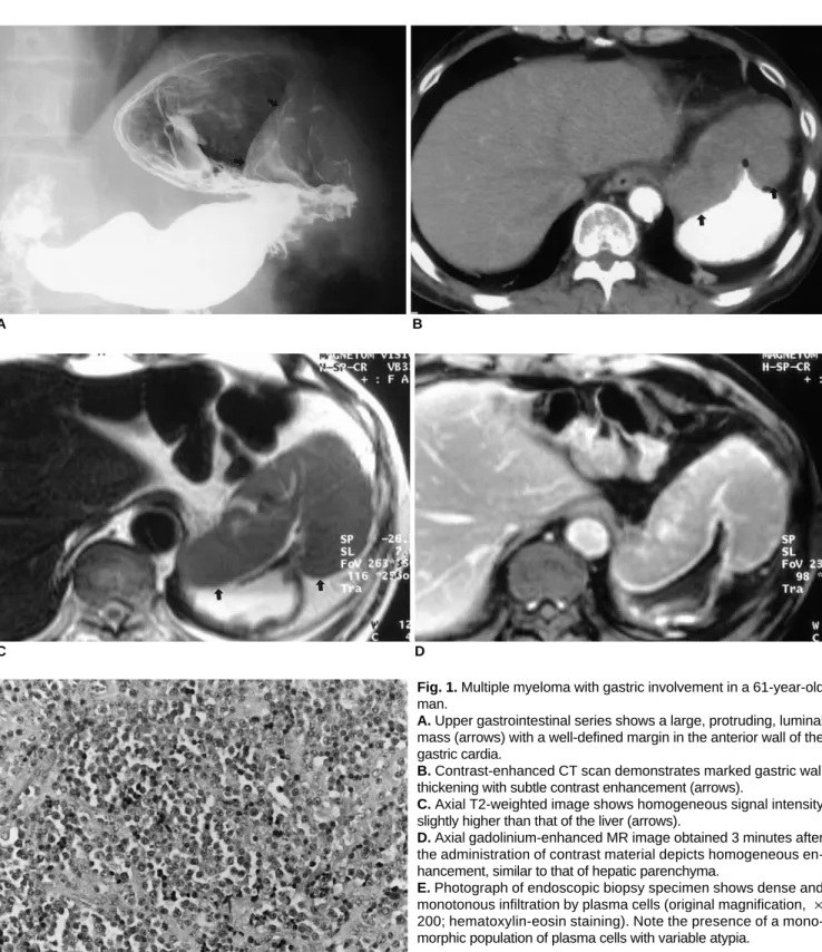 Fig. 1. Multiple myeloma with gastric involvement in a 61-year-old man.