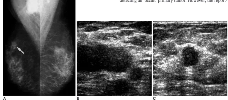 Fig. 1. A 64-year-old woman with axillary node metastasis.
