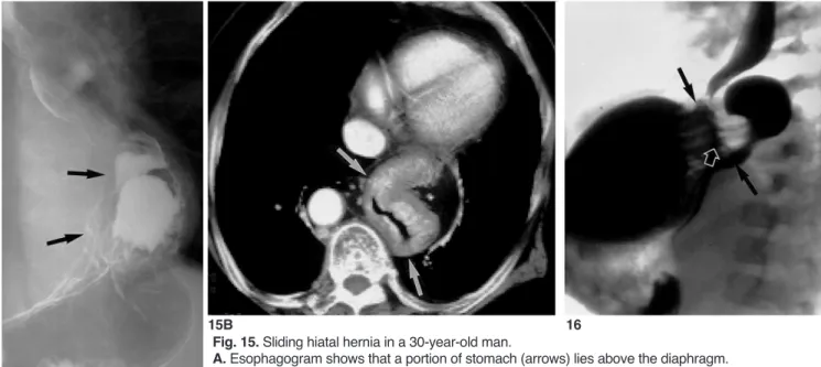 Fig. 16. Paraesophageal hernia in a 2-year-old boy. 