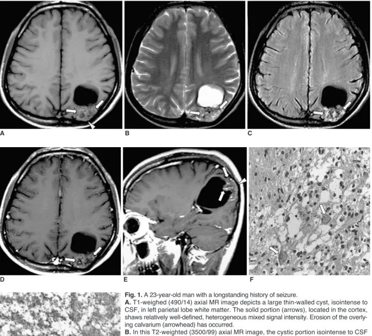Fig. 1. A 23-year-old man with a longstanding history of seizure.