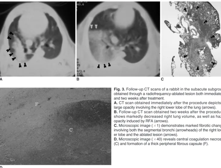 Table 2. Summary of Complications Related to Radio-Frequency Ablation Procedure