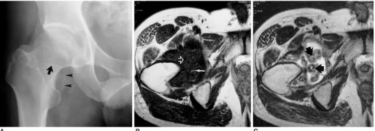 Fig. 2. A 37-year-old man with idiopathic synovial osteochondromatosis of the right hip.