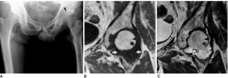 Fig. 4. A 59-year-old man with idiopathic synovial osteochondromatosis of the left hip.