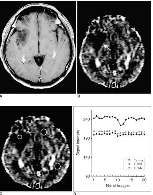 Fig. 3. Case 19: Low-grade astrocytoma in a 41-year-old man.