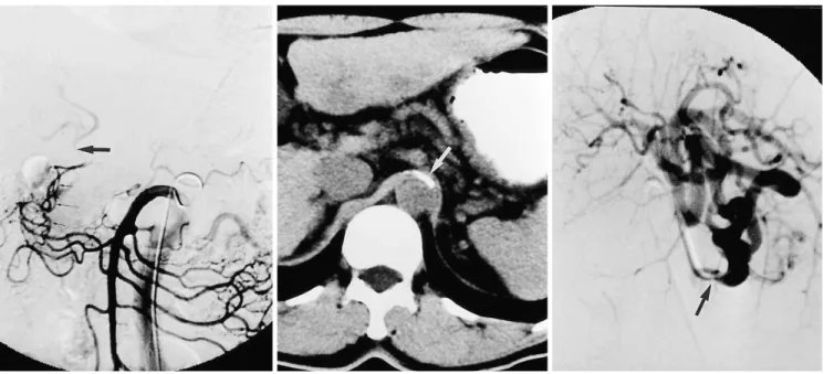 Fig. 2. A 54-year-old man with significant CA stenosis due to atherosclerosis.