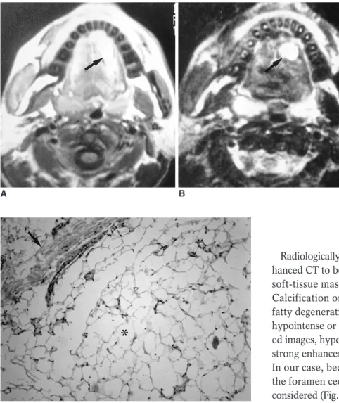 Fig. 1. Lipoma in a 40-year-old man with a non-tender, soft mass at the left  dor-sum of the tongue