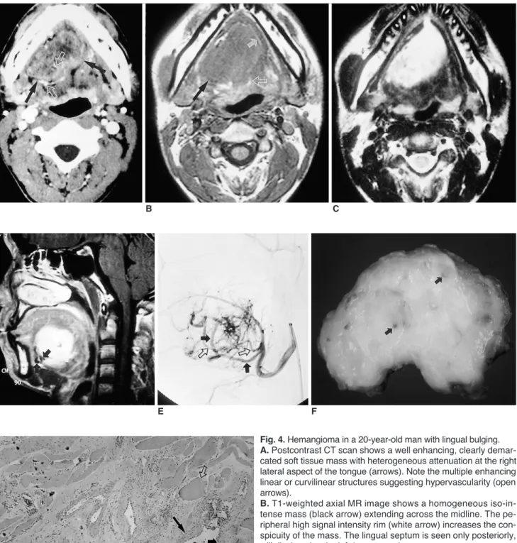 Fig. 4. Hemangioma in a 20-year-old man with lingual bulging. 
