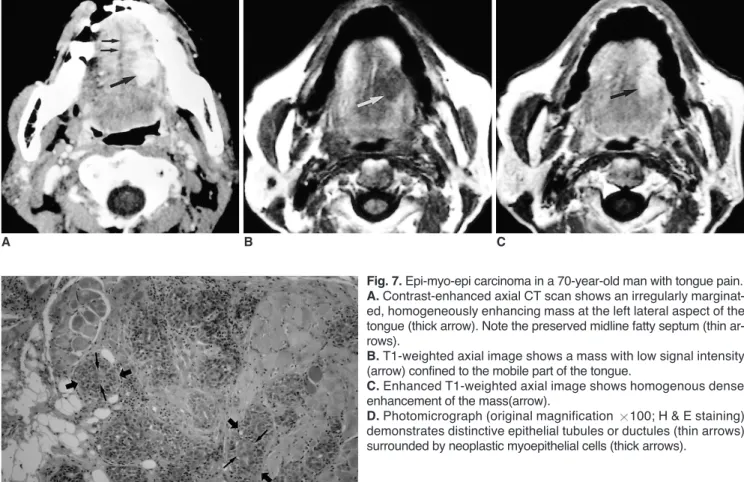 Fig. 8. Lymphoma in a 78-year-old-man with palpable neck mass.