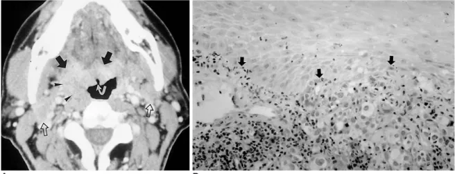 Fig. 9. Metastasis from carcinoma of the bronchus in a 48-year-old man. 