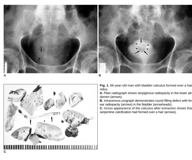 Fig. 1. 66-year-old man with bladder calculus formed over a hair nidus.