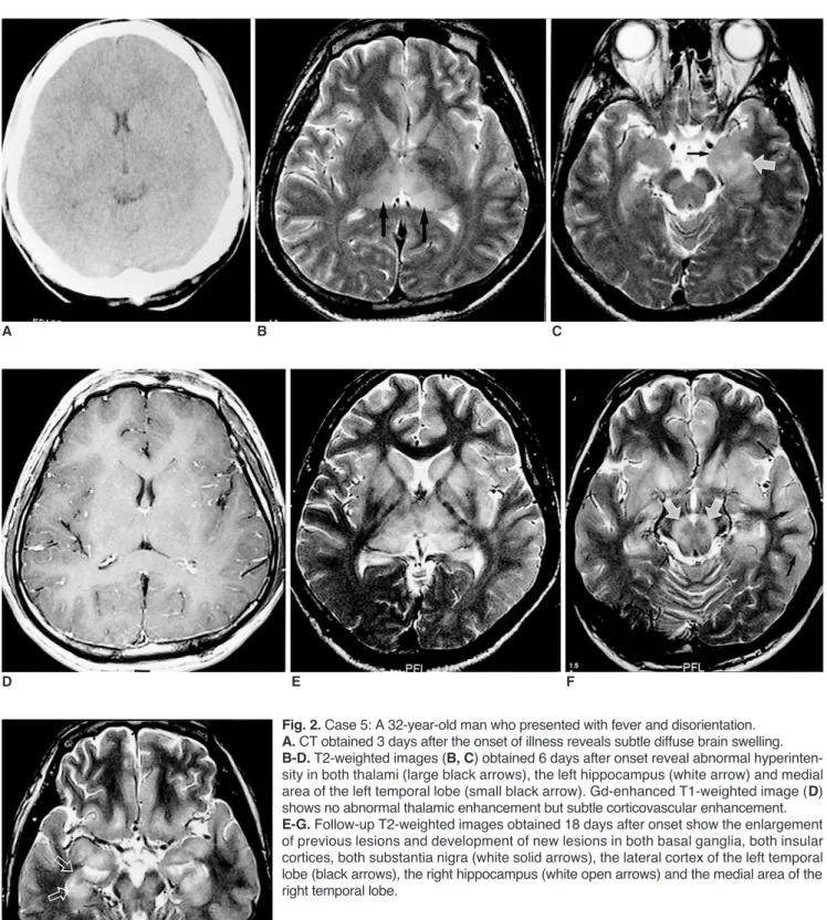 Fig. 2. Case 5: A 32-year-old man who presented with fever and disorientation.