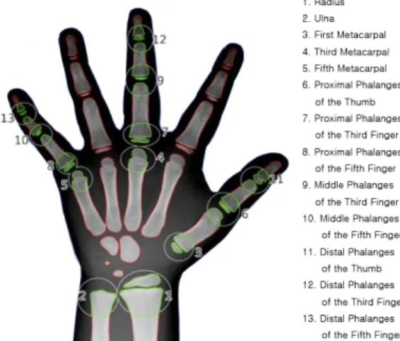 Fig.  1  Separation  Position  of  Hand  Bone